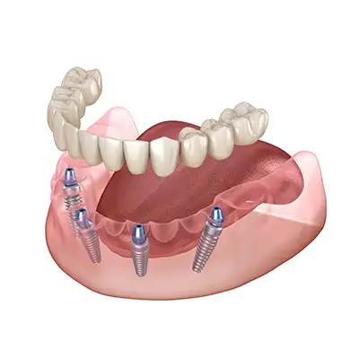All on Four İmplant